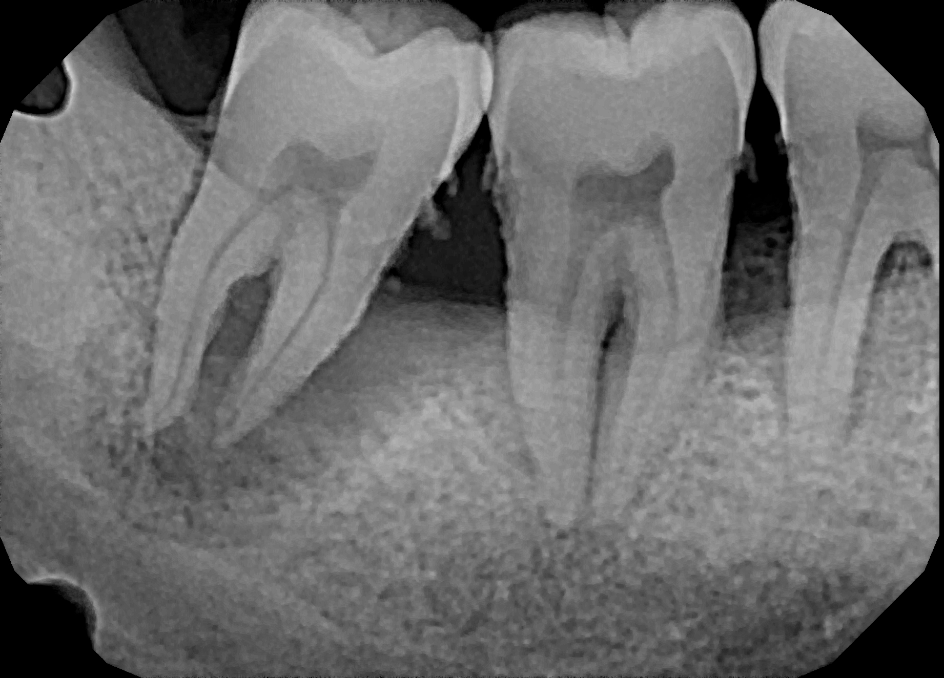 Tooth xray